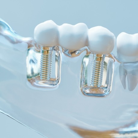 Model of the jaw with two dental implants in Mount Prospect