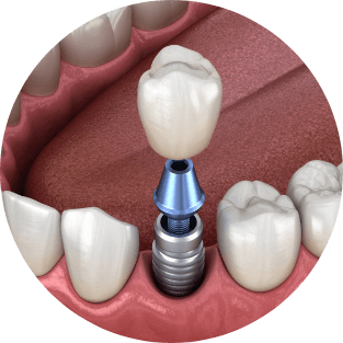 Animated dental implant with dental crown