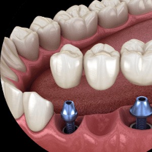 Two animated dental implants with dental bridge 