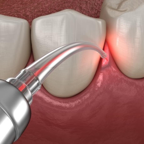 Animated dental laser treating diseased gums