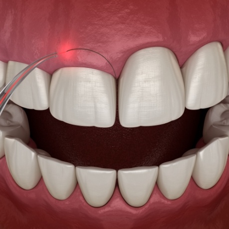 Animated laser gum grafting procedure