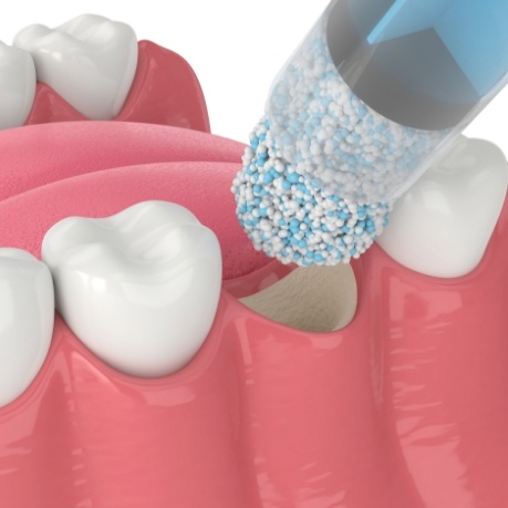 Animated bone grafting material being placed in jawbone where missing tooth was