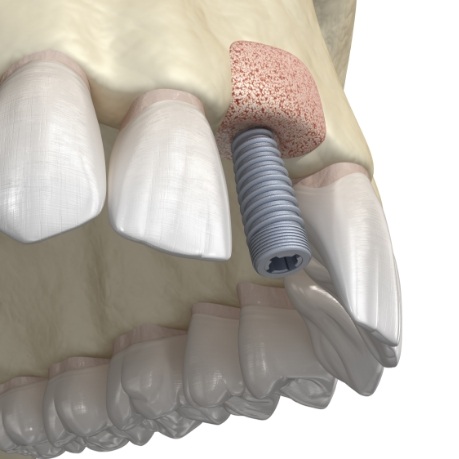 Animated dental implant in upper jaw