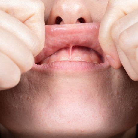 Close up of person lifting and stretching their upper lip