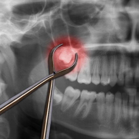 Dental forceps on top of x ray showing impacted wisdom tooth highlighted red